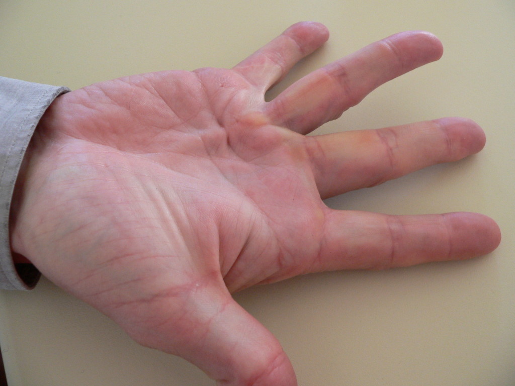 Dupuytren fisioterapia Milano