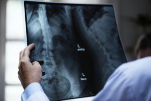 osteoporosi limfa therapy milano